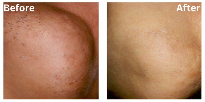 Results Permanent Choice Permanent Choice Laser Hair Removal